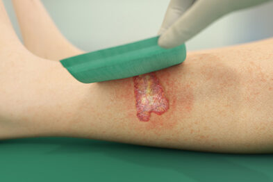Sorbact Absorption-bandage placeres over et sår på benet.